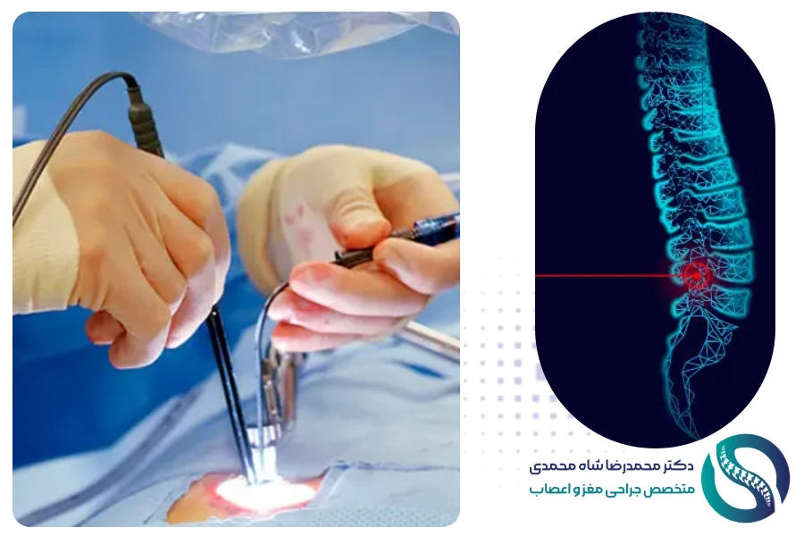 جراحی لیزر دیسک کمر - دکتر محمدرضا شاه محمدی