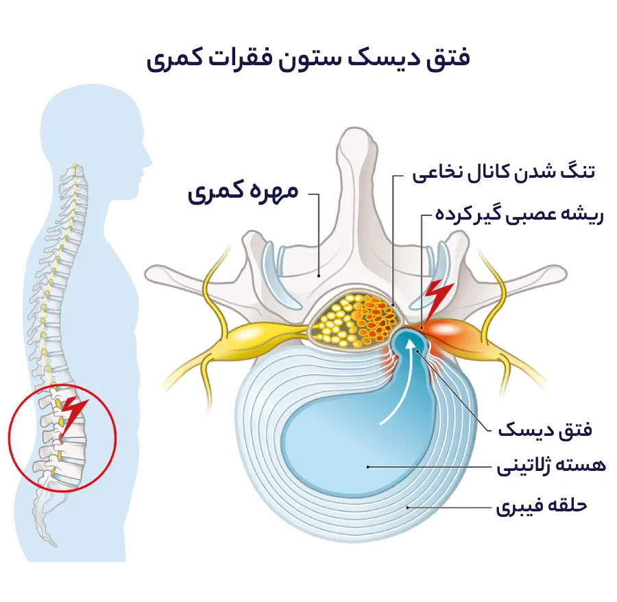 آناتومی و مشکل دیسک کمر - فتق دیسک کمر - دکتر محمدرضا شاه محمدی