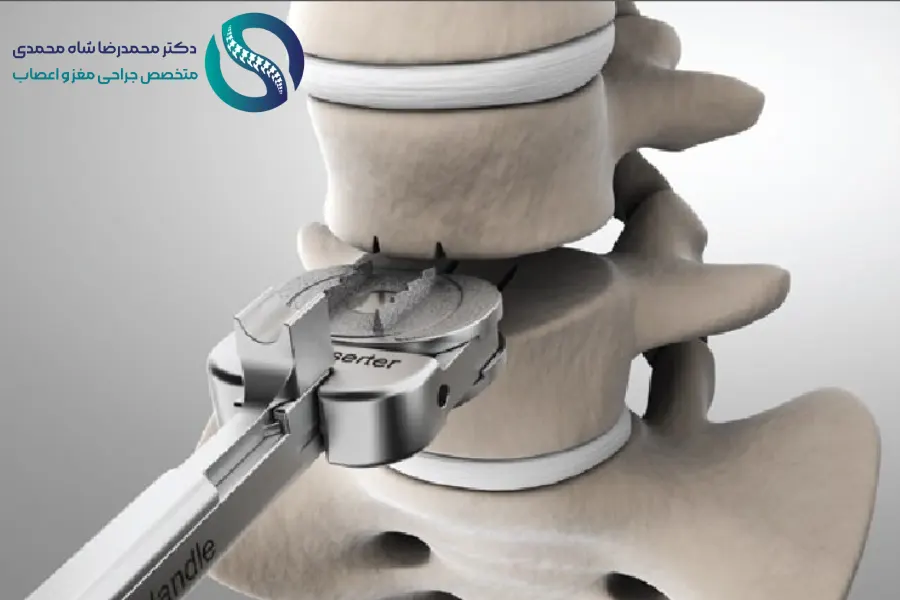 جایگزینی دیسک مصنوعی برای درمان دیسک کمر - دکتر محمدرضا شاه محمدی