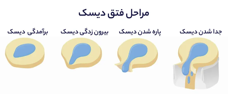 مراحل فتق دیسک - دکتر محمدرضا شاه محمدی