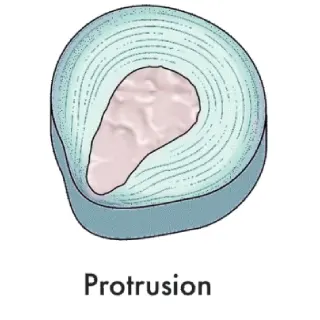 بیرونزدگی یا پروتروژن (Disc Protrusion) - دکتر محمدرضا شاه محمدی