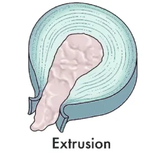 اکستروژن (Disc Extrusion) - دکتر محمدرضا شاه محمدی