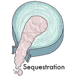 جدا شدن یا سکستریشن (Sequestration) - دکتر محمدرضا شاه محمدی