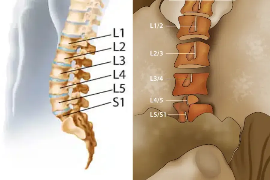 دیسک کمر بیشتر در کدام مهرهها اتفاق میافتد؟ - دکتر محمدرضا شاه محمدی