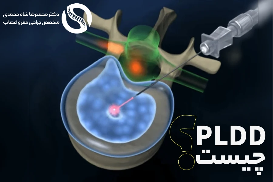 عمل لیزر دیسک کمر (PLDD) چیست؟ - دکتر محمدرضا شاه محمدی