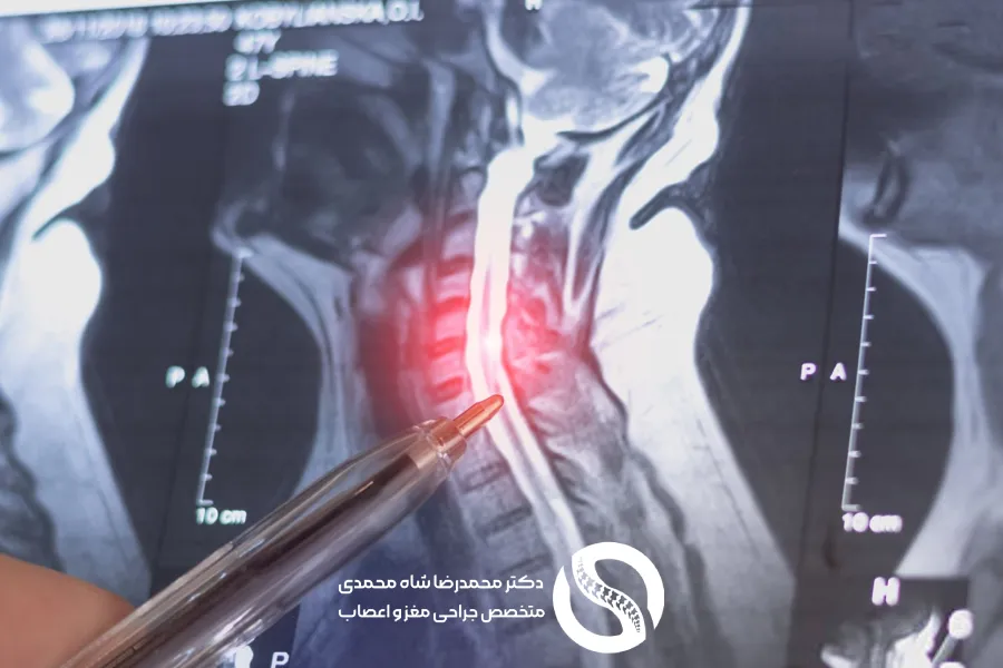 MRI بهترین ابزار برای تشخیص دیسک گردن - دکتر محمدرضا شاه محمدی
