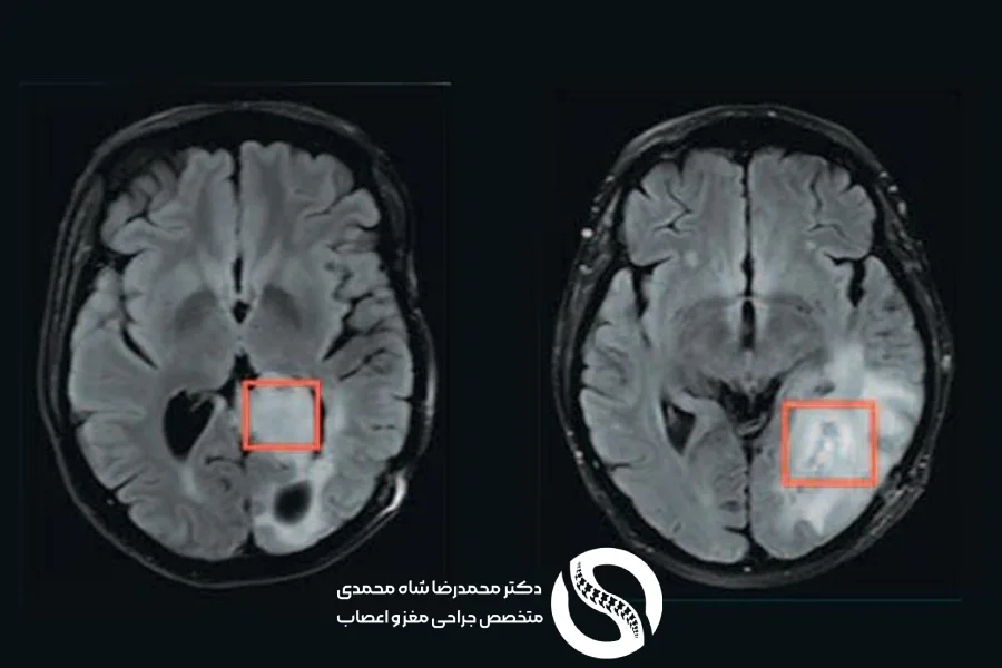 علائم تومور مغزی، تمام نشانه و راههای تشخیص تومور مغزی - دکتر محمدرضا شاه محمدی