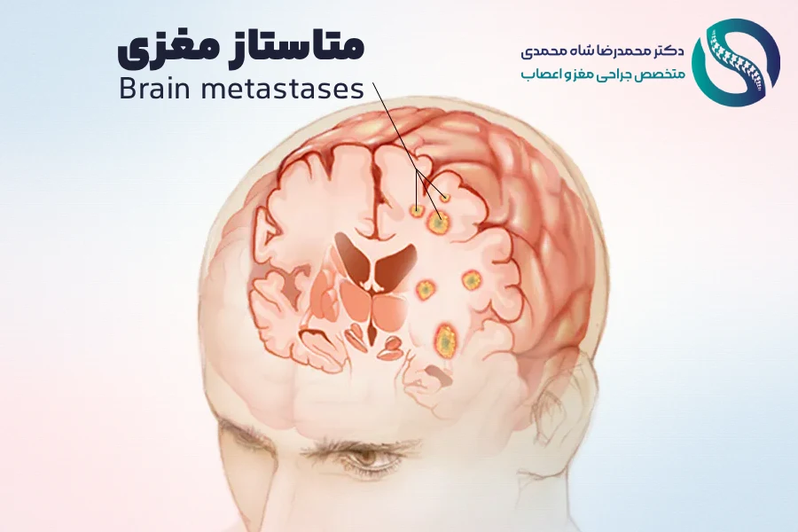 سرطانی که به مغز گسترش مییابد - متاستاز مغزی - دکتر محمدرضا شاه محمدی