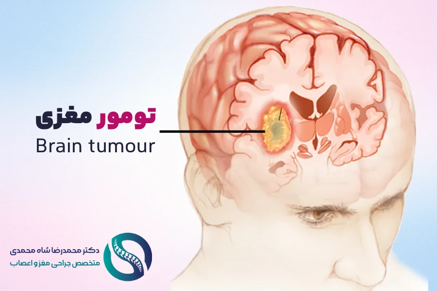 تومور مغزی چیست؟ - دکتر محمدرضا شاه محمدی