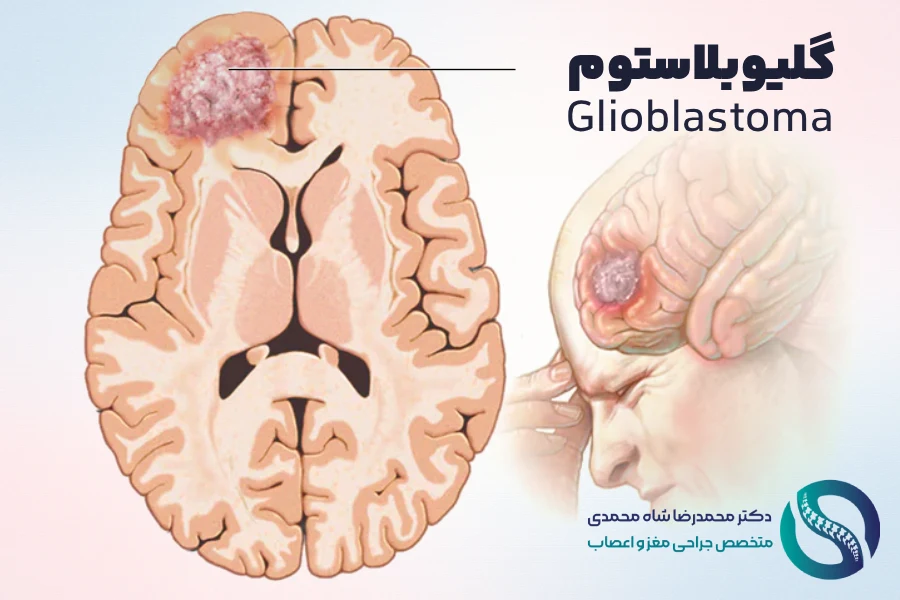 تومور مغزی گلیوبلاستوم - Glioblastoma - دکتر محمدرضا شاه محمدی