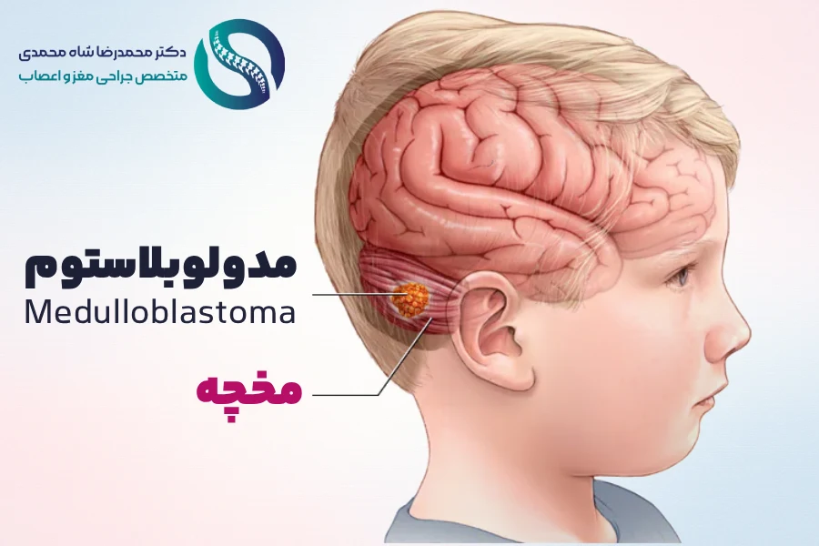 تومور مغزی مدولوبلاستوم - Medulloblastoma - دکتر محمدرضا شاه محمدی