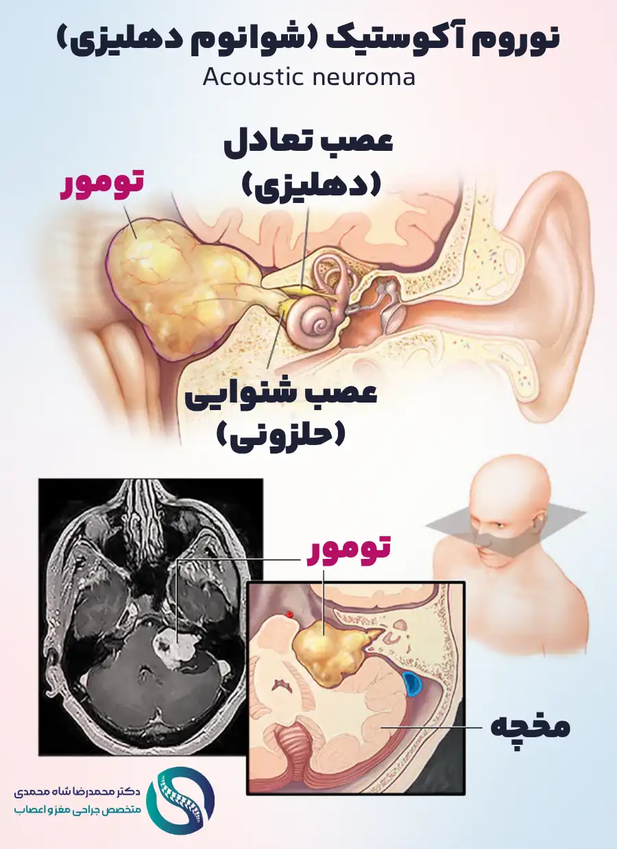تومور مغزی نوروم آکوستیک (شوانوم دهلیزی) - Acoustic neuroma - دکتر محمدرضا شاه محمدی