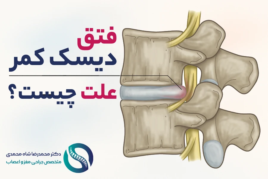 علت فتق دیسک کمر چیست؟ - دکتر محمدرضا شاه محمدی