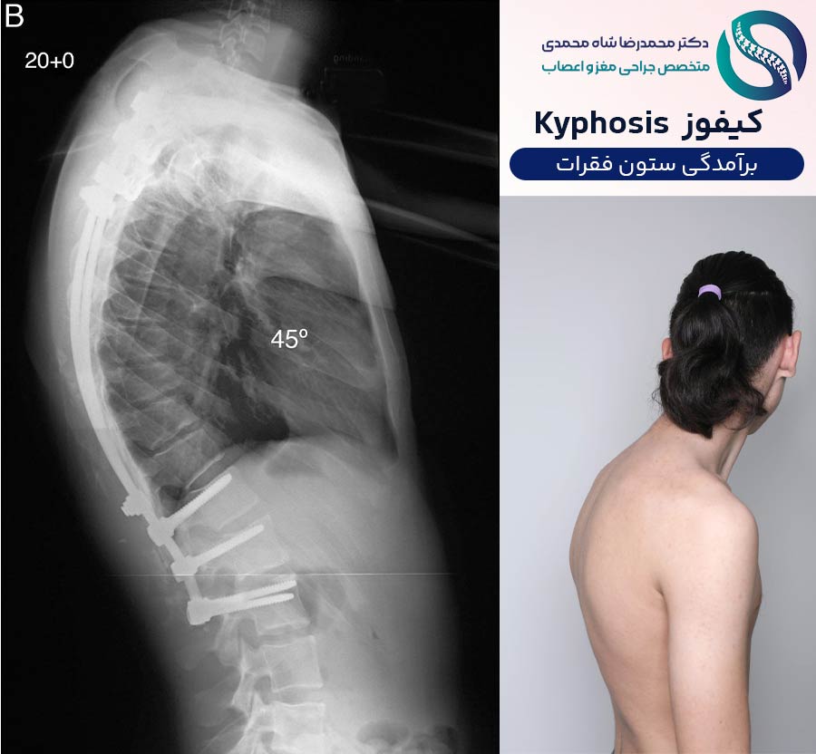 کیفوز؛ برآمدگی ستون فقرات - دکتر محمدرضا شاه محمدی