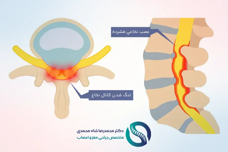 تنگی کانال نخاعی کمر چیست؟ | علائم و روش های درمان - دکتر شاه محمدی جراح دیسک کمر تهران