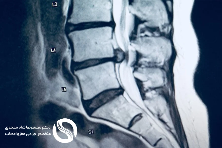 سندرم دم اسب و تنگی کانال نخاع کمری - دکتر شاه محمدی جراح دیسک کمر