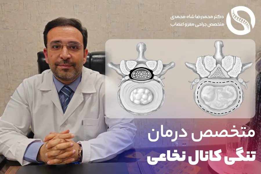 درمان تنگی کانال نخاعی کمر توسط دکتر شاه محمدی متخصص دیسک کمر