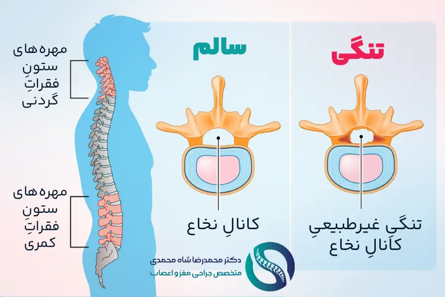 تنگی کانال نخاعی کمر - دکتر شاه محمدی جراح دیسک کمر تهران