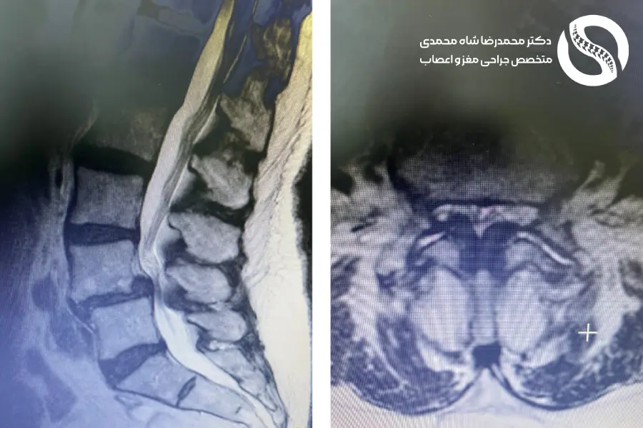 تصویر MRI کمری که تنگی شدید L45 را نشان میدهد - دکتر شاه محمدی جراح دیسک کمر