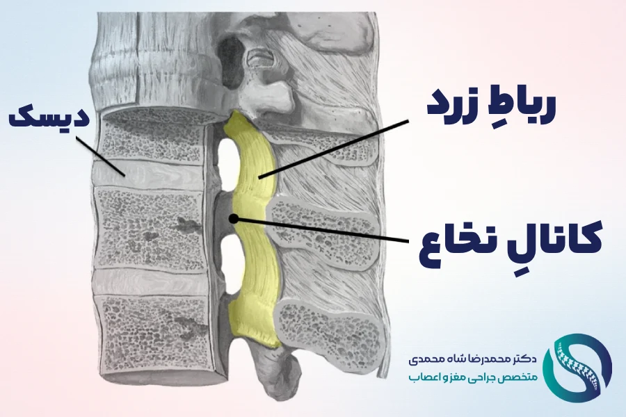 رباط زرد و تنگی کانال نخاع کمری - دکتر شاه محمدی جراح دیسک کمر