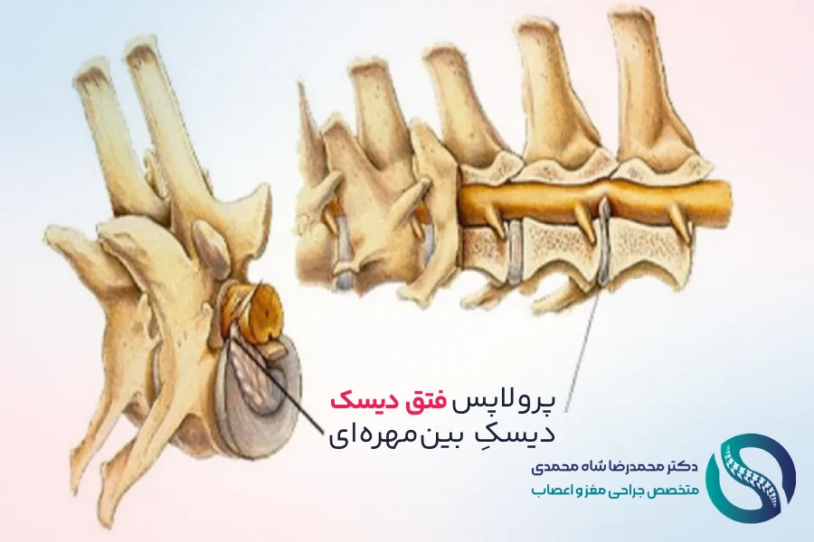دیسکهای بین مهرهای و تنگی کانال نخاعی - دکتر شاه محمدی جراح دیسک کمر