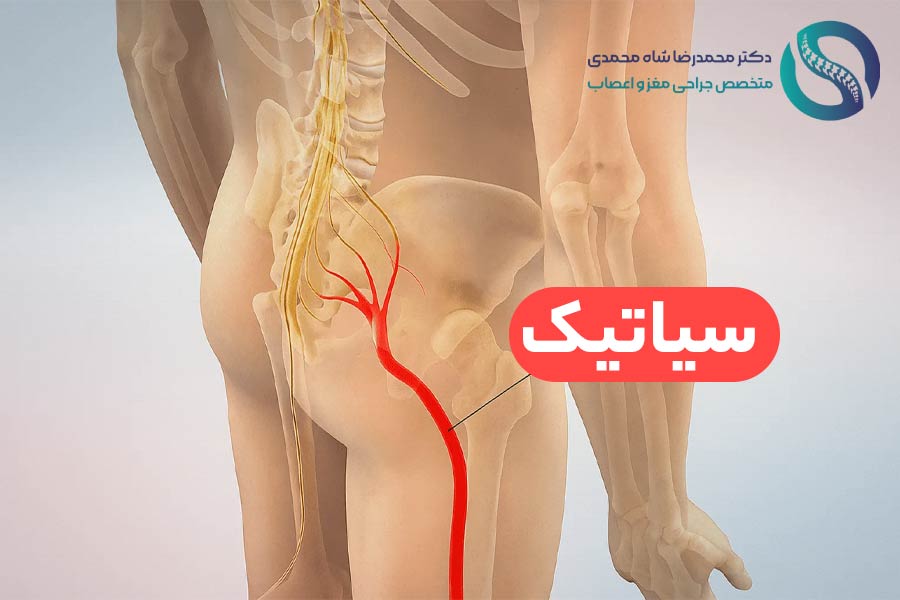 سیاتیک چیست؟ علائم سیاتیک و بهترین روش درمان عصب سیاتیک - دکتر محمدرضا شاه محمدی
