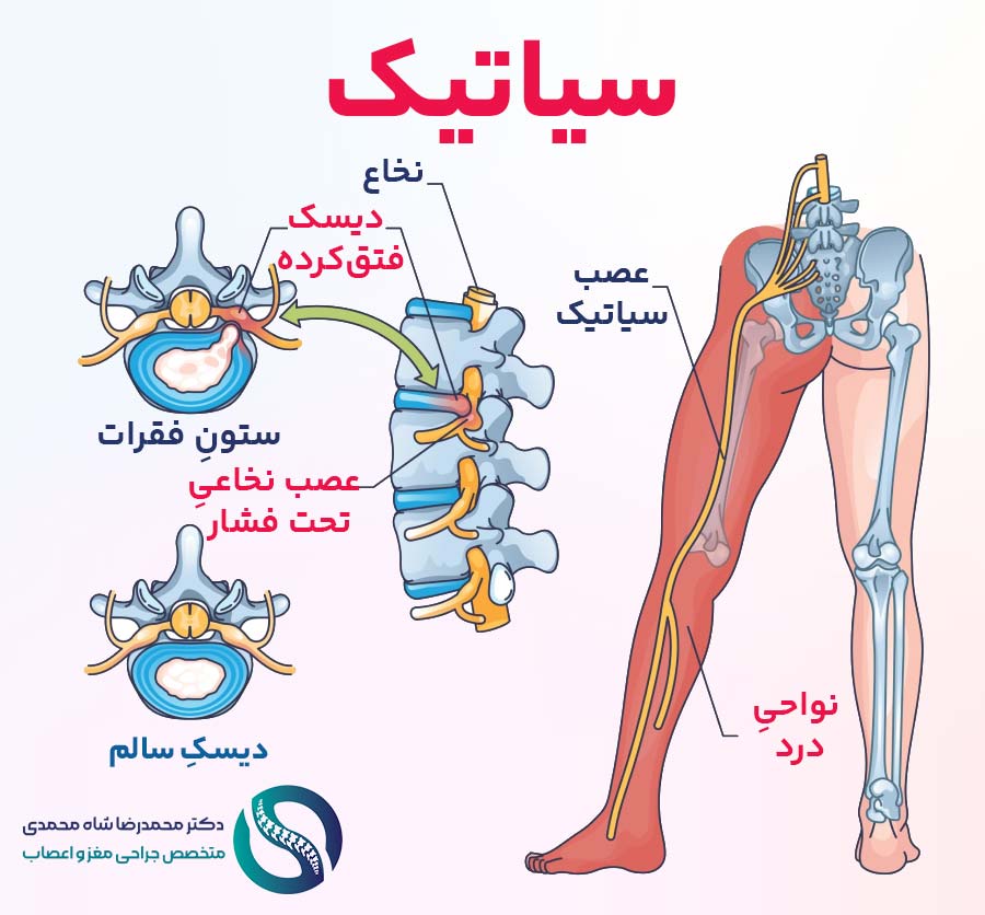 سیاتیک چیست؟ - دکتر محمدرضا شاه محمدی