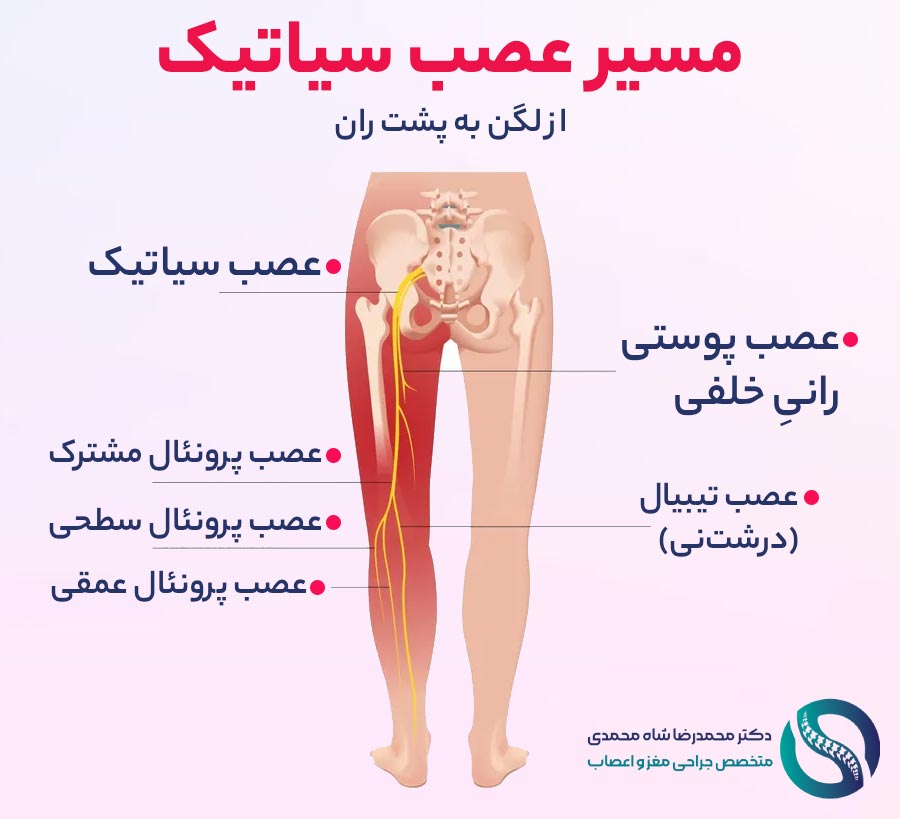 مسیر عصب سیاتیک در بدن - دکتر محمدرضا شاه محمدی