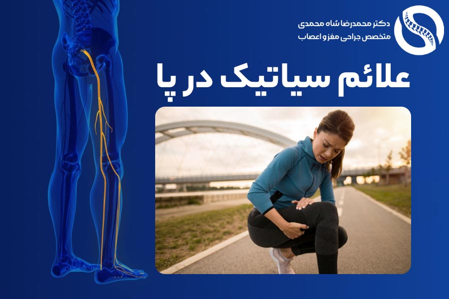 علائم سیاتیک در پای چپ یا راست - دکتر محمدرضا شاه محمدی
