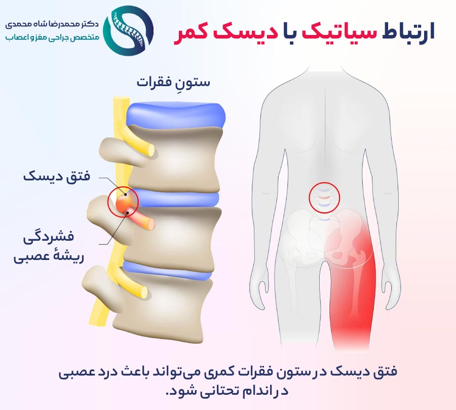 ارتباط سیاتیک با دیسک کمر - دکتر محمدرضا شاه محمدی