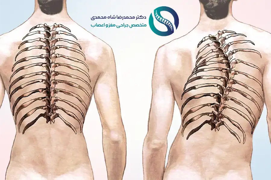 انحراف ستون فقرات چیست؟ از علائم تا روش درمان - دکتر شاه محمدی