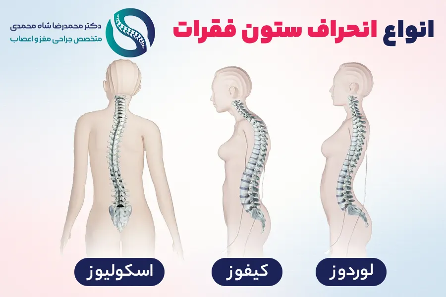 انواع انحراف ستون فقرات - دکتر شاه محمدی جراح انحراف ستون فقرات