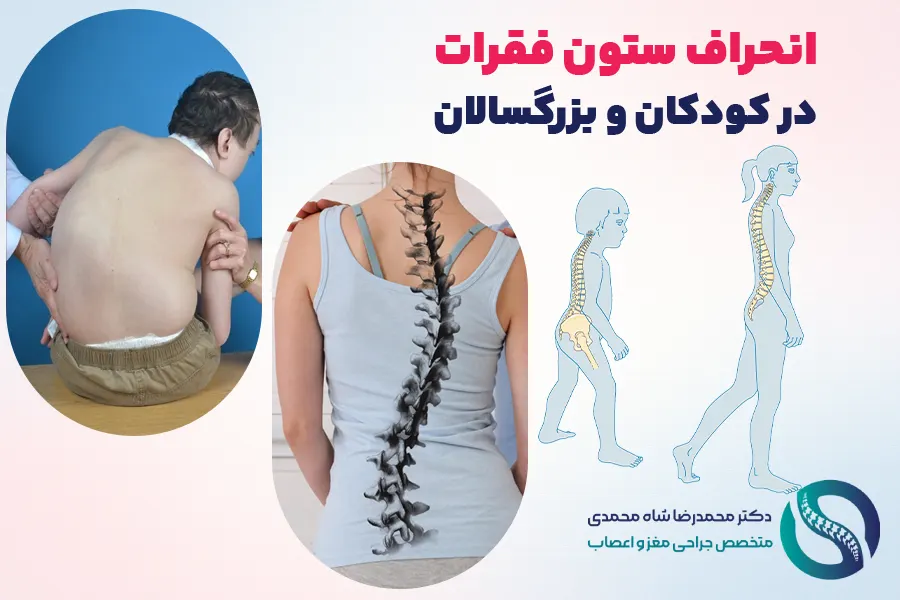 انحراف ستون فقرات در کودکان و بزرگسالان - دکتر شاه محمدی جراح انحراف ستون فقرات