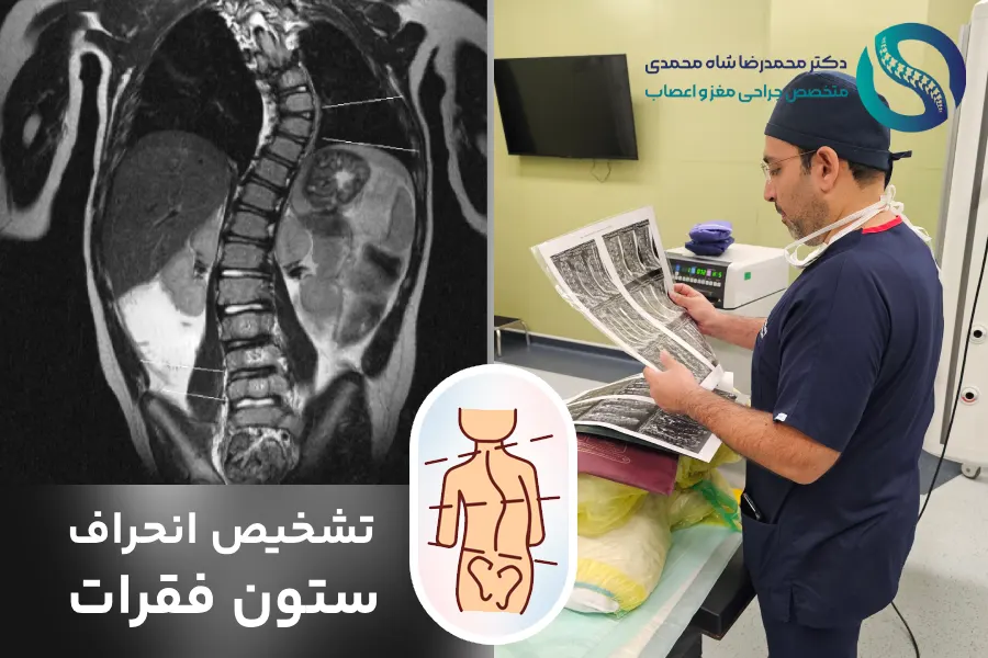 تشخیص انحراف ستون فقرات - دکتر شاه محمدی جراح مغز و اعصاب در تهران