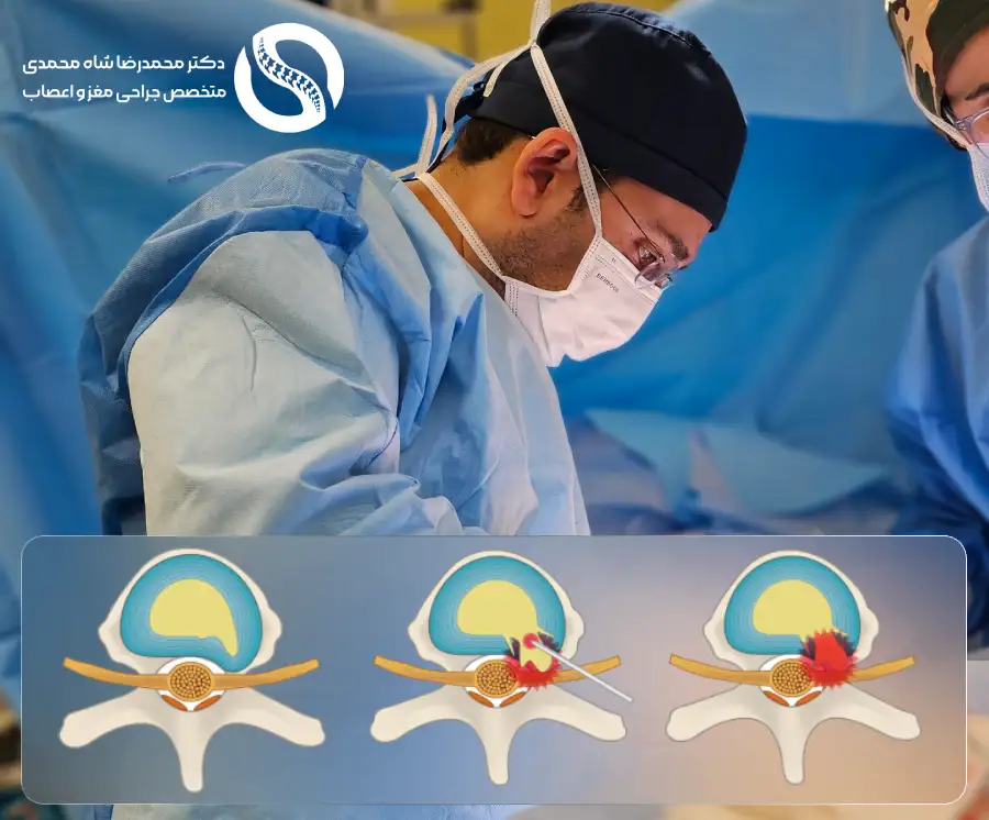 نظر دکتر شاه محمدی در مورد عمل دیسک کمر با لیزر