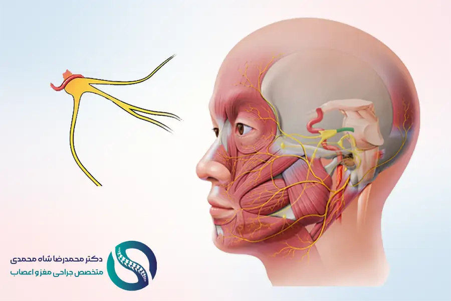 نورالژی عصب سه قلو (تری ژمینال) چیست؟ و روش درمان آن - دکتر شاه محمدی