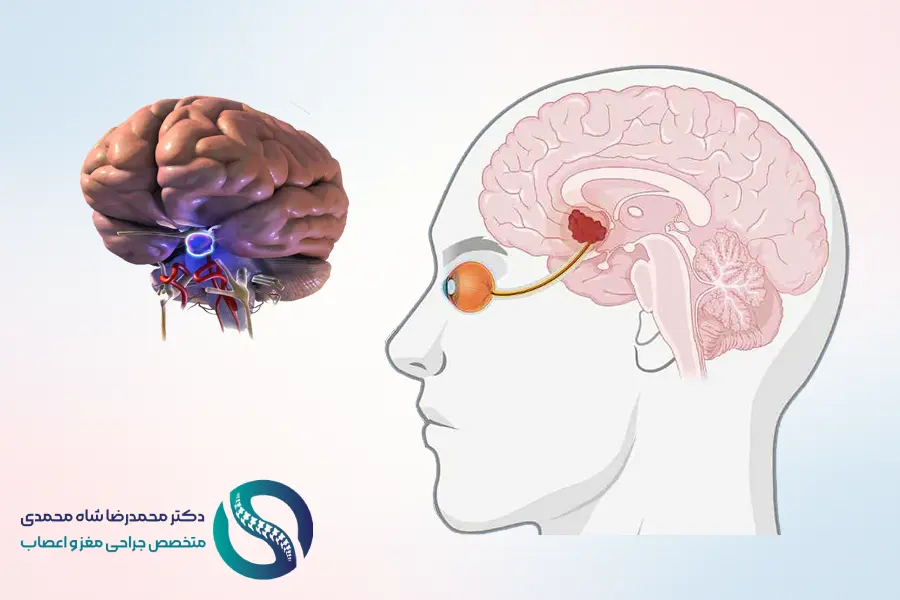تومور مغزی پشت چشم چیست؟ علائم، علت و روش درمان آن - دکتر محمدرضا شاه محمدی جراح مغز و اعصاب در تهران