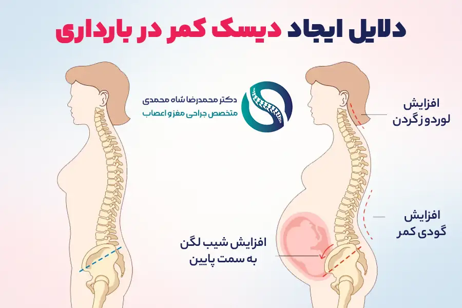دلایل ابتلا به دیسک کمر در بارداری - دکتر شاه محمدی جراح دیسک کمر تهران