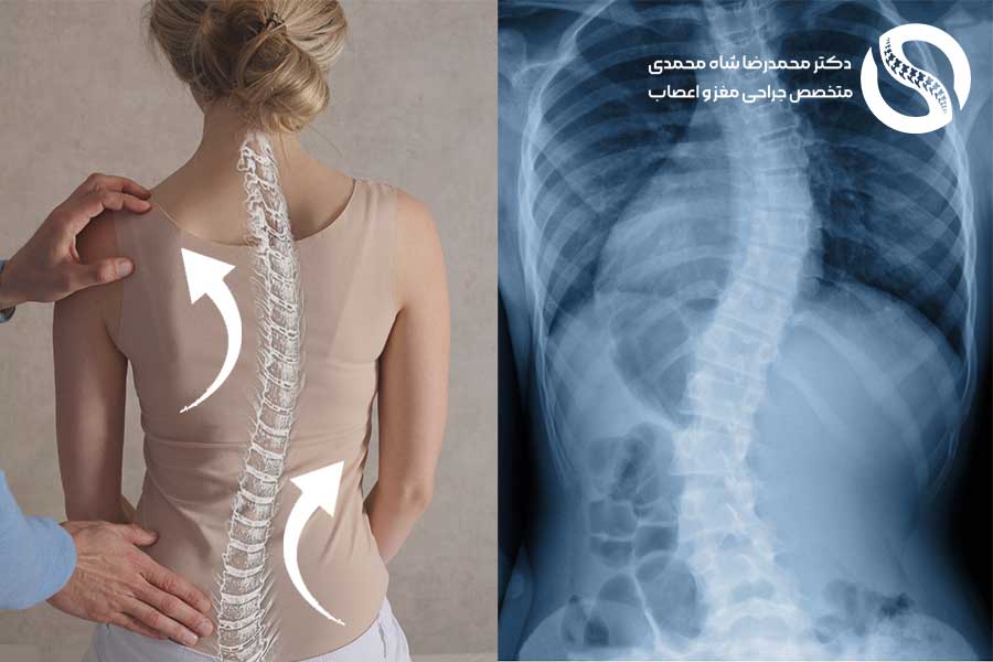 اسکولیوز چیست؟ از علائم و عوارض تا تشخیص و درمان اسکولیوز - دکتر محمدرضا شاه محمدی