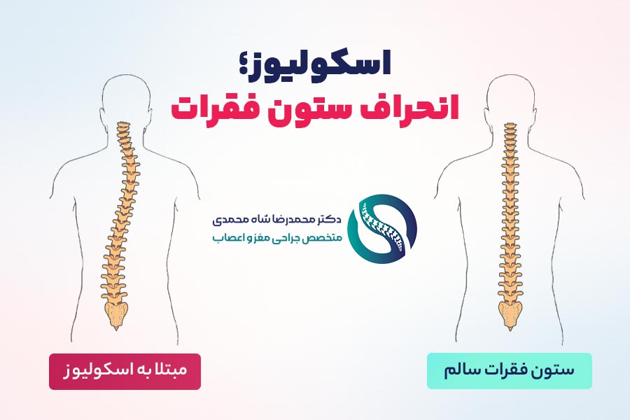 اسکولیوز - انحراف ستون فقرات - دکتر محمدرضا شاه محمدی