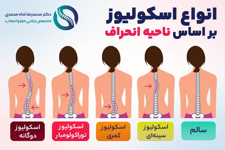 انواع اسکولیوز بر اساس ناحیۀ درگیری - دکتر محمدرضا شاه محمدی