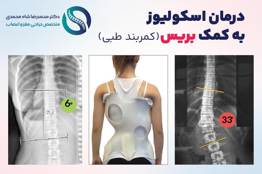 استفاده از بریس (کمربند طبی) برای درمان اسکولیوز در کودکان و نوجوانانی که هنوز در حال رشد هستند - دکتر محمدرضا شاه محمدی