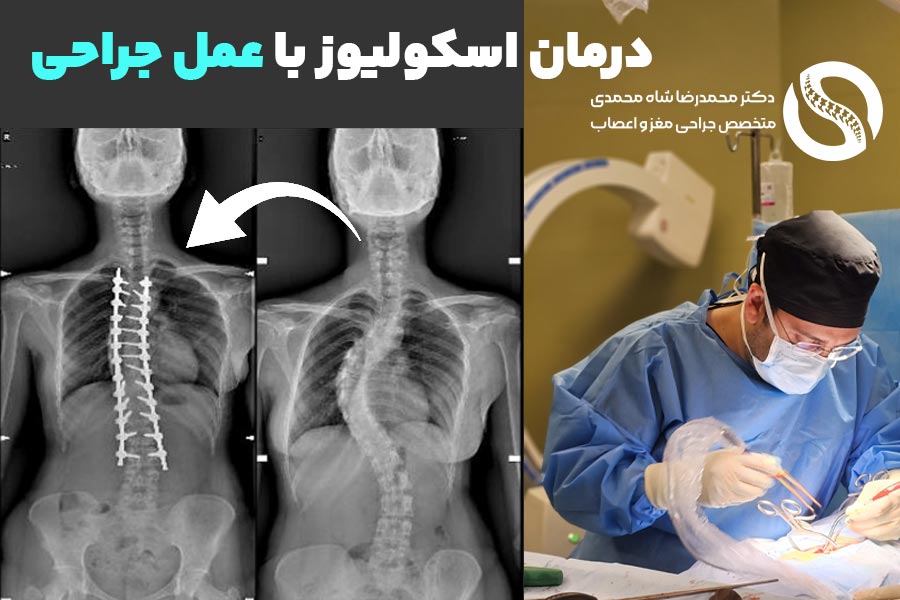 درمان اسکولیوز با عمل جراحی - دکتر محمدرضا شاه محمدی جراح اسکولیوز در تهران