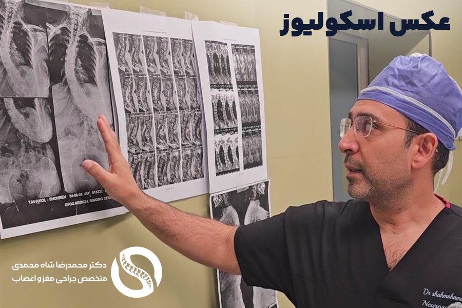 نحوۀ تشخیص اسکولیوز توسط پزشک متخصص : دکتر محمدرضا شاه محمدی جراح اسکولیوز در تهران