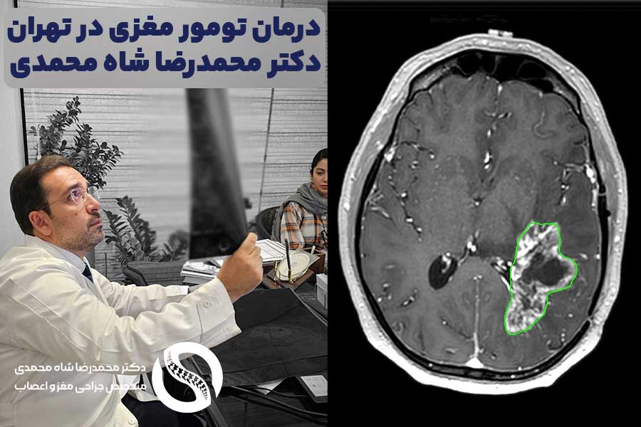 درمان تومور مغزی توسط دکتر محمدرضا شاه محمدی جراح تومور مغزی در تهران