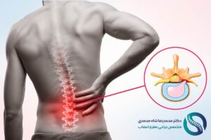 علت عود دیسک کمر بعد از عمل جراحی چیست؟