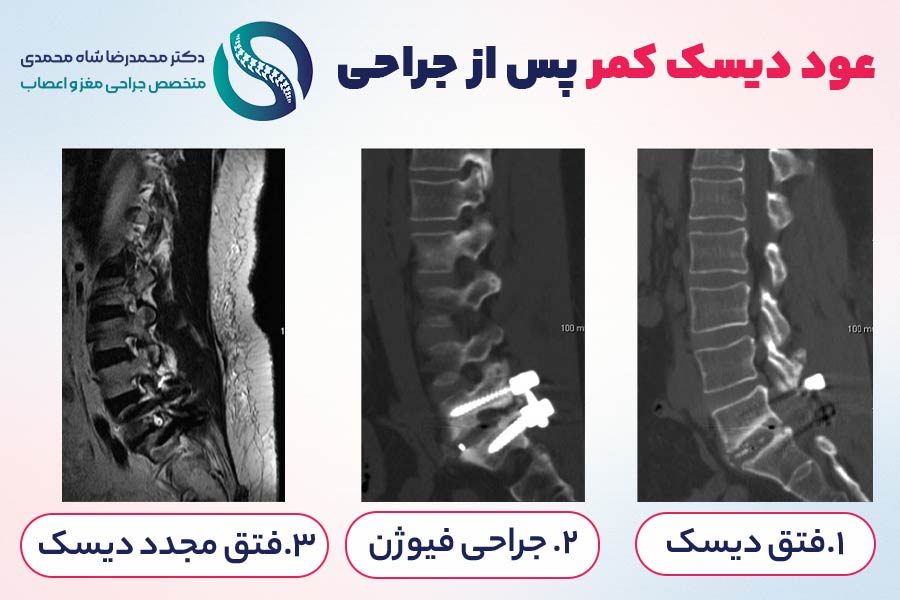 عود مجدد دیسک کمر پس از جراحی فیوژن